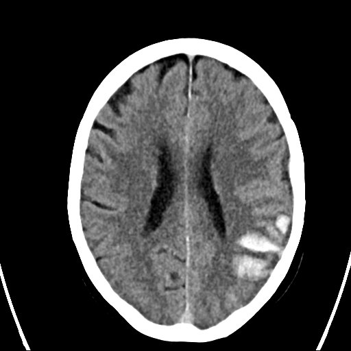 File:Cerebral venous infarction with hemorrhage (Radiopaedia 65343-74381 Axial non-contrast 16).jpg