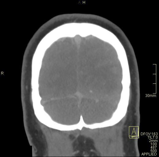 Cerebral venous sinus thrombosis (Radiopaedia 91329-108965 Coronal venogram 78).jpg