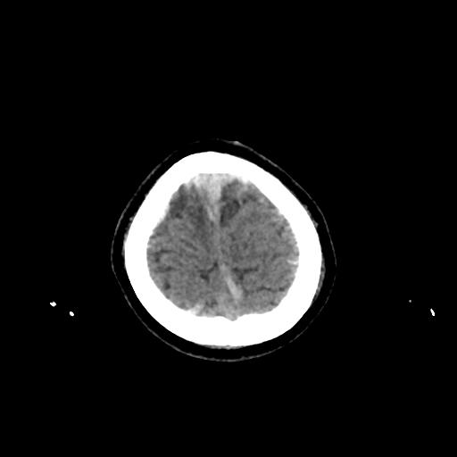 File:Cerebral venous throbmosis - hemorrhagic venous infarction (Radiopaedia 87318-103613 Axial non-contrast 160).jpg
