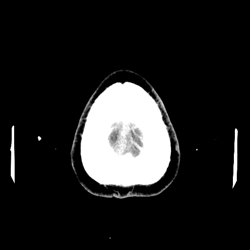 File:Cerebral venous thrombosis (CVT) (Radiopaedia 77524-89685 Axial non-contrast 46).jpg