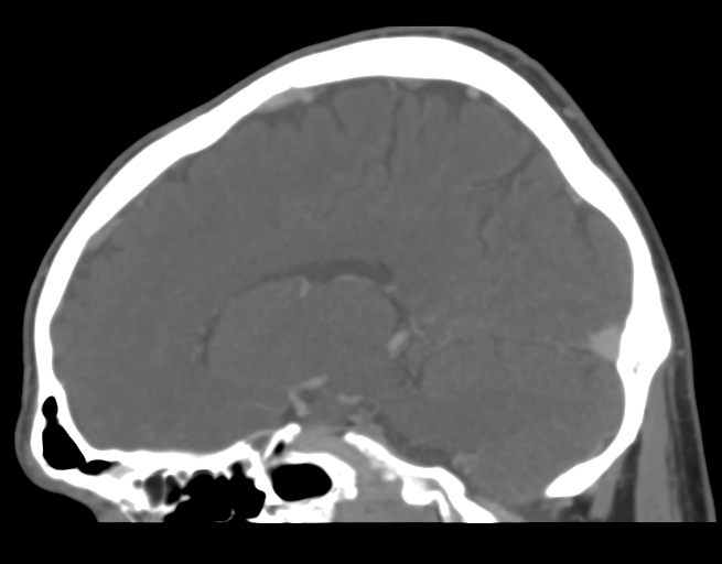 File:Cerebral venous thrombosis (Radiopaedia 38392-40467 D 31).png