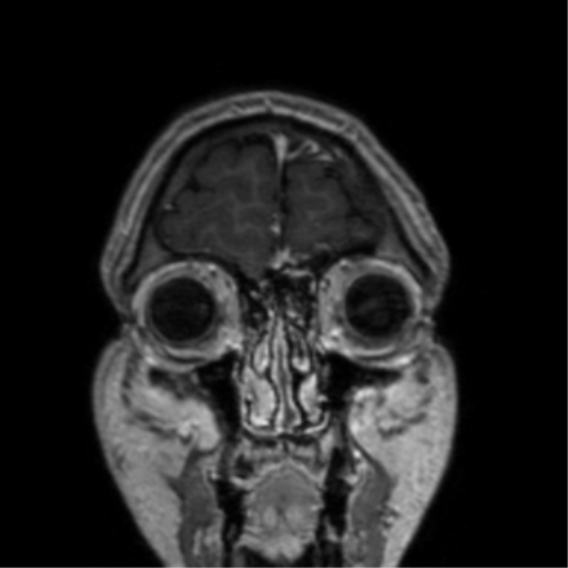 Cerebral venous thrombosis (Radiopaedia 38392-40469 Coronal T1 C+ 80).png