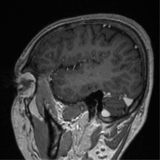 Cerebral venous thrombosis (Radiopaedia 38392-40469 Sagittal T1 C+ 23).png