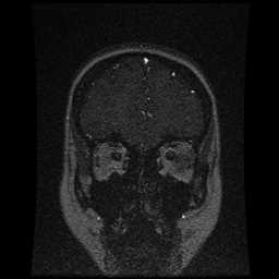 Cerebral venous thrombosis - ulcerative colitis (Radiopaedia 66049-75219 Coronal MRV 96).jpg