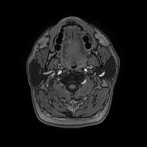 File:Cerebral venous thrombosis with secondary intracranial hypertension (Radiopaedia 89842-106957 Axial T1 C+ 10).jpg