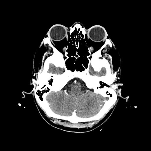 Cerebral venous thrombosis with venous hemorrhagic infarct (Radiopaedia 90354-107660 Axial with contrast 37).jpg