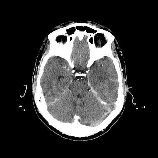 Cerebral venous thrombosis with venous hemorrhagic infarct (Radiopaedia 90354-107660 Axial with contrast 59).jpg