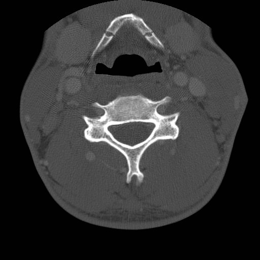 Cervical Pott disease (Radiopaedia 20374-20286 Axial bone window 81).jpg