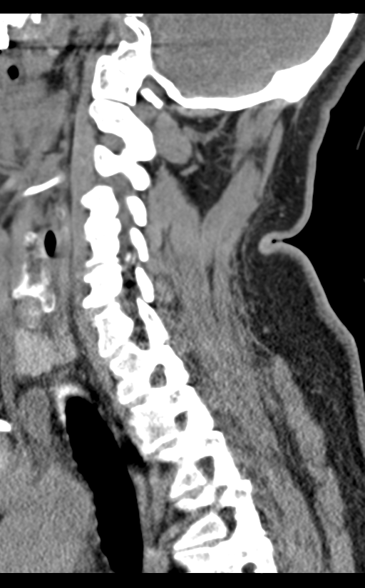 Cervical canal stenosis - OPLL and osteophytes (Radiopaedia 47329-51910 B 50).png
