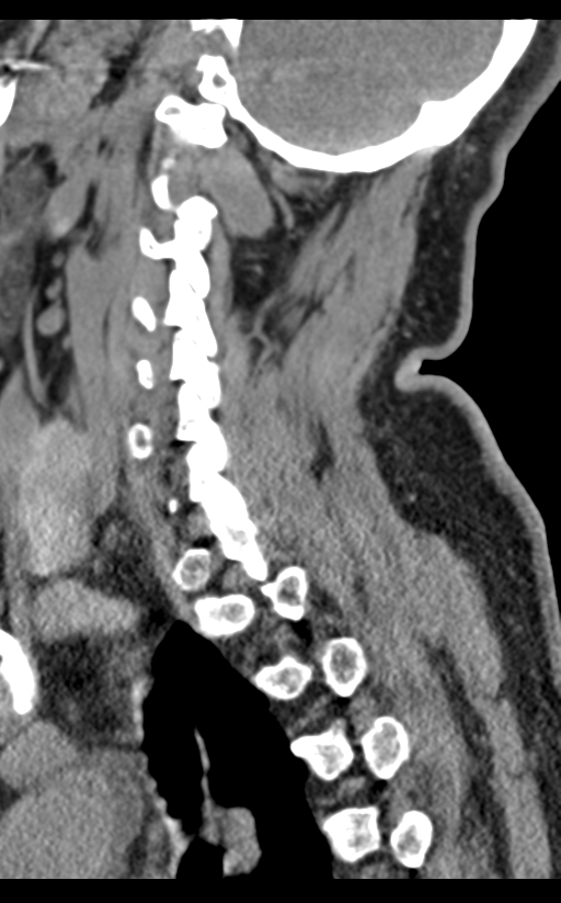 Cervical canal stenosis due to ossification of the posterior longitudinal ligament (Radiopaedia 47260-51823 D 56).png