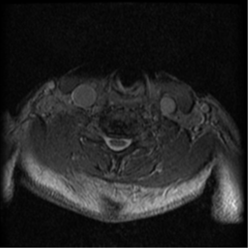 Cervical canal stenosis with cord compression (Radiopaedia 34114-35374 Axial Gradient Echo 31).png