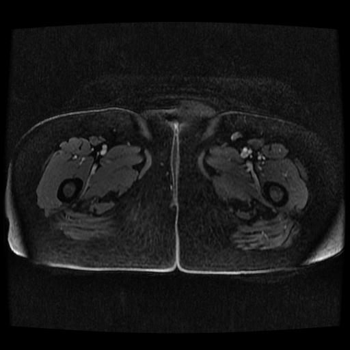 Cervical carcinoma (Radiopaedia 70924-81132 Axial T1 C+ fat sat 9).jpg