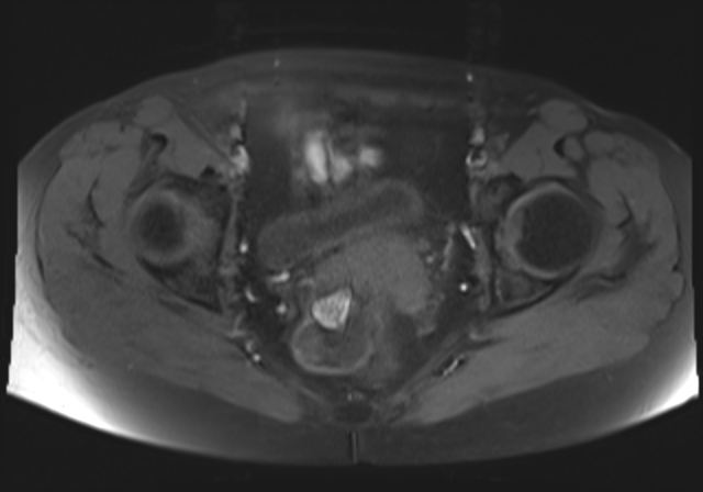 File:Cervical carcinoma (Radiopaedia 88312-104943 Axial T1 fat sat 14).jpg