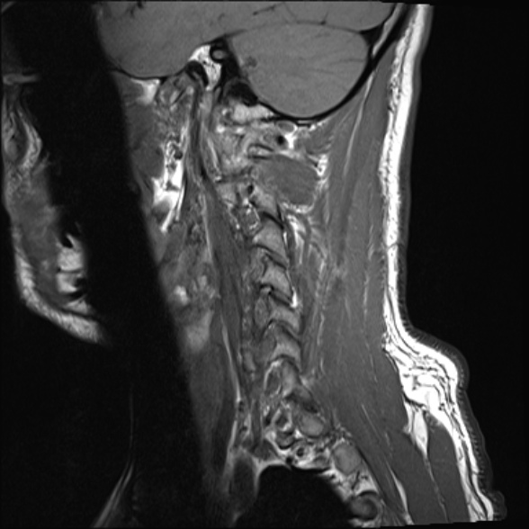File:Cervical disc extrusion (Radiopaedia 53950-60077 Sagittal T1 3).jpg