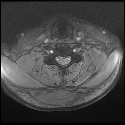 Cervical disc extrusion (Radiopaedia 59074-66364 F 36).jpg