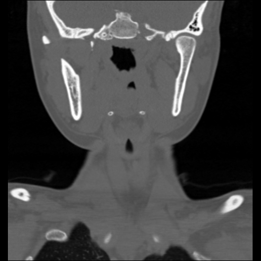 File:Cervical rib (Radiopaedia 71110-81363 Coronal non-contrast 37).jpg