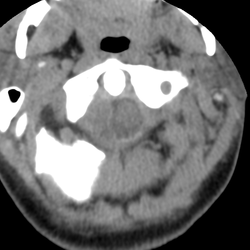 Cervical schwannoma (Radiopaedia 57979-64974 Axial non-contrast 14).png