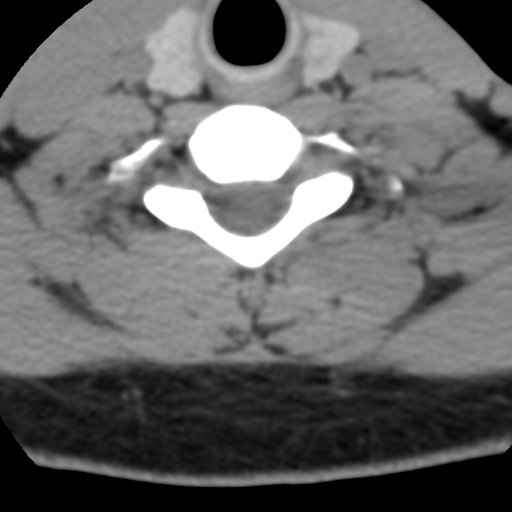 Cervical schwannoma (Radiopaedia 57979-64974 Axial non-contrast 49).png