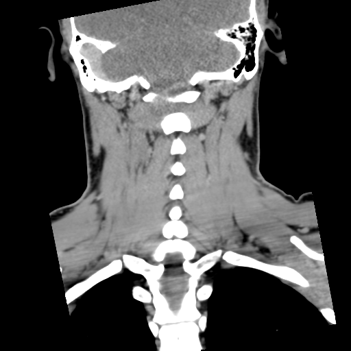 Cervical schwannoma (Radiopaedia 57979-64974 G 44).png