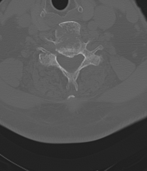 File:Cervical spine fracture in the setting of ankylosis (Radiopaedia 37038-38715 Axial bone window 40).png