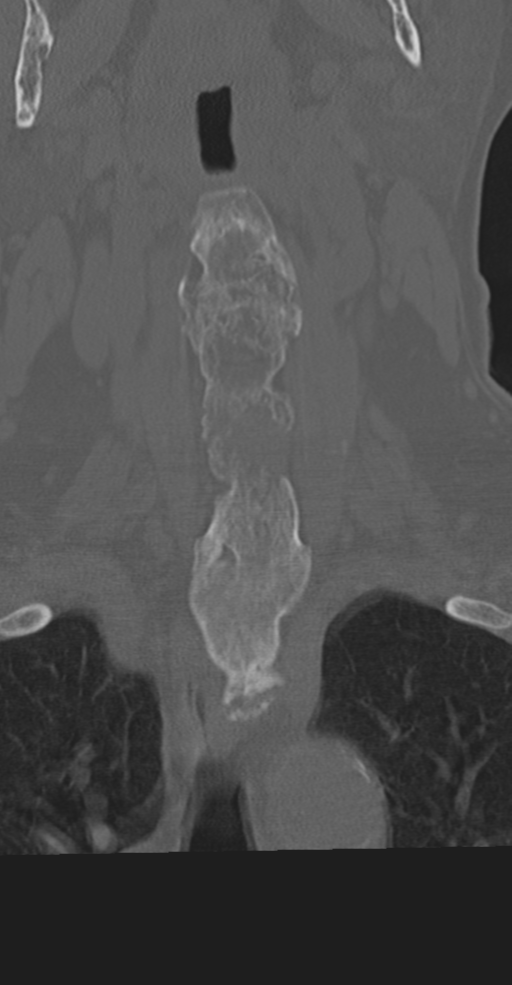 Cervical spine fracture in the setting of ankylosis (Radiopaedia 37038-38715 Coronal bone window 20).png