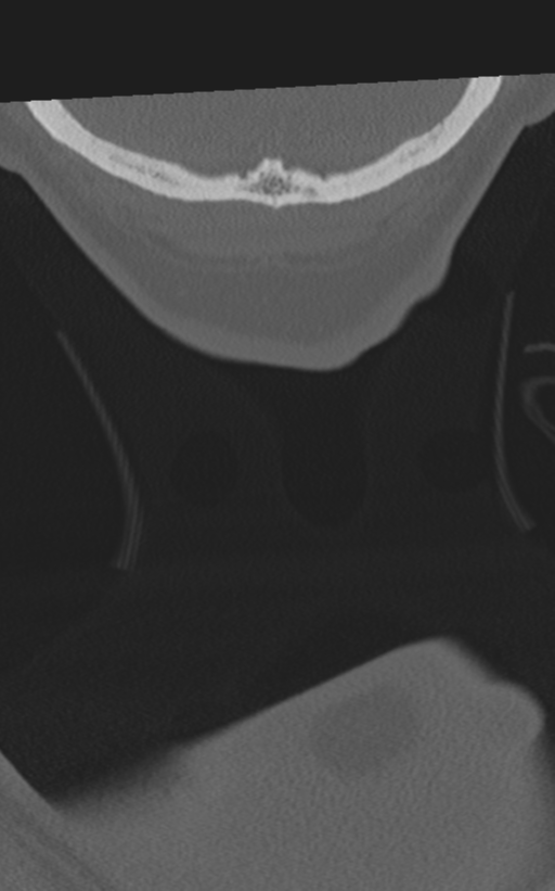 Cervical spine fractures with vertebral artery dissection (Radiopaedia 53296-59268 Coronal bone window 87).png