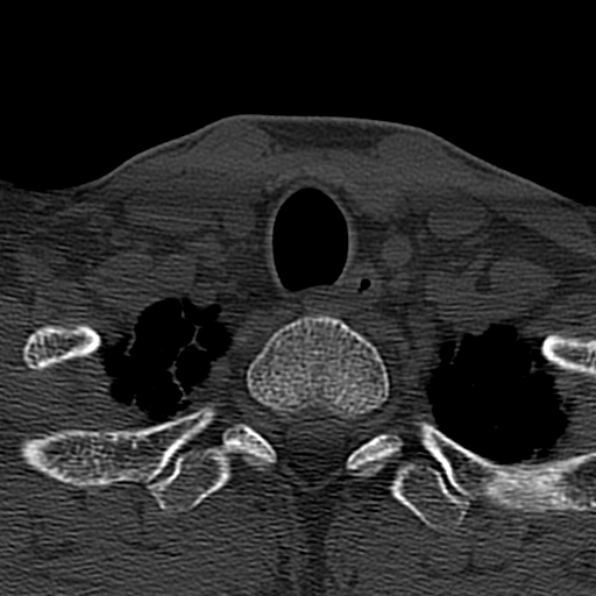 Cervical spondylodiscitis (Radiopaedia 28057-29489 Axial bone window 72).jpg