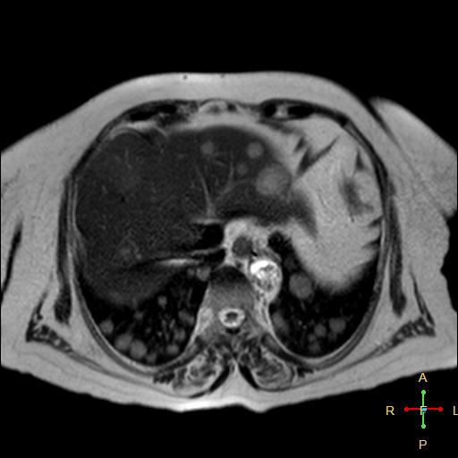 File:Cervical stump squamous cell carcinoma (Radiopaedia 48049-52858 I 17).jpg