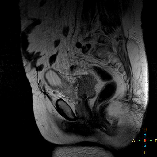 File:Cervical stump squamous cell carcinoma (Radiopaedia 48049-52858 Sagittal T2 6).jpg
