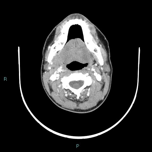 Cervical thymic cyst (Radiopaedia 88632-105335 B 79).jpg