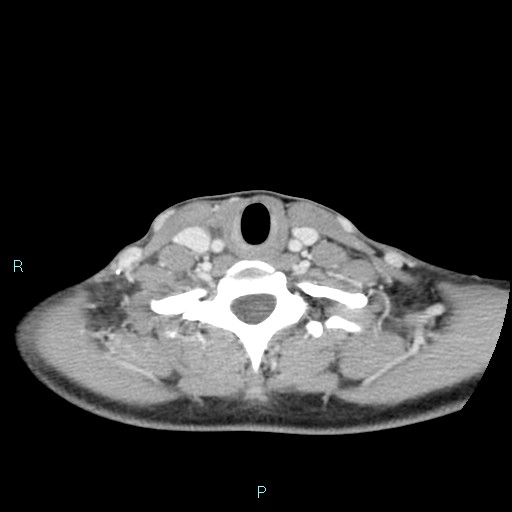 Cervical thymic cyst (Radiopaedia 88632-105335 C 41).jpg