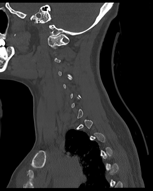Cervical tuberculous spondylitis (Radiopaedia 39149-41365 Sagittal bone window 51).png