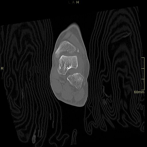Chaput tubercle fracture (Radiopaedia 80319-93956 Coronal non-contrast 33).jpg