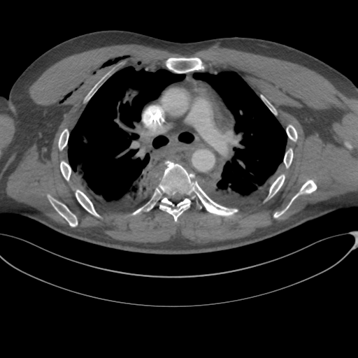 File:Chest multitrauma - aortic injury (Radiopaedia 34708-36147 A 122).png