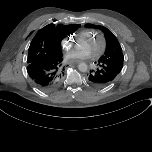 File:Chest multitrauma - aortic injury (Radiopaedia 34708-36147 A 176).png