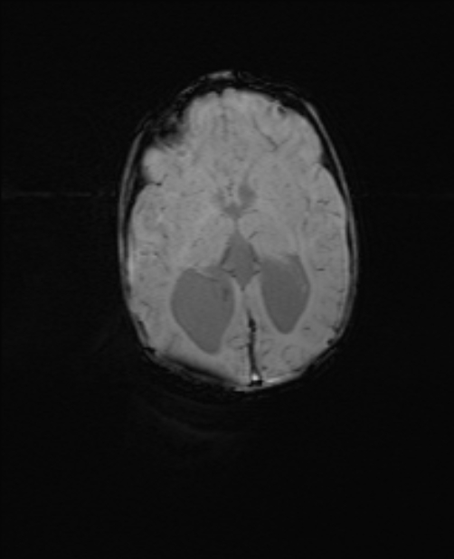 Chiari III malformation with occipital encephalocele (Radiopaedia 79446-92559 Axial SWI 38).jpg