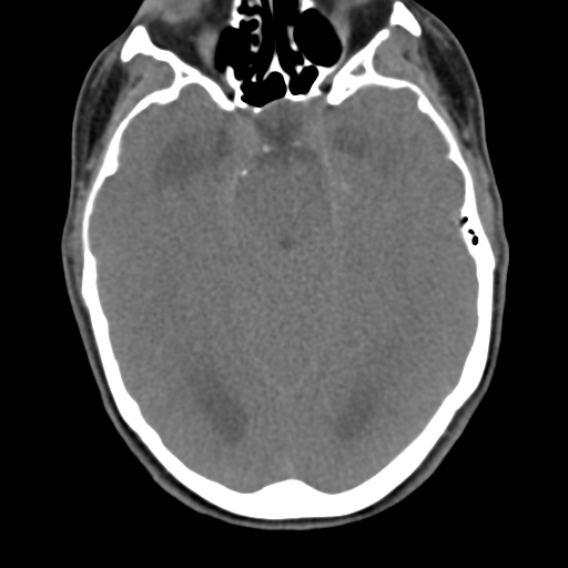 File:Chiari I malformation and obstructive hydrocephalus (Radiopaedia 41185-43981 D 18).png