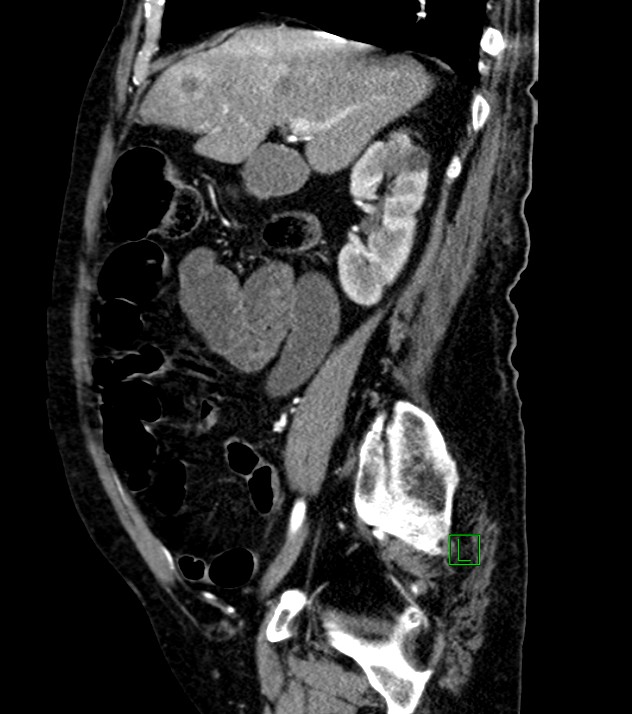 Cholangiocarcinoma with cerebral metastases (Radiopaedia 83519-98629 F 80).jpg
