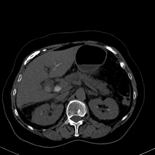 File:Cholecystitis - obstructive choledocholitiasis (CT intravenous cholangiography) (Radiopaedia 43966-47479 Axial 84).png