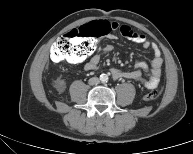 File:Cholecystitis - perforated gallbladder (Radiopaedia 57038-63916 A 50).jpg
