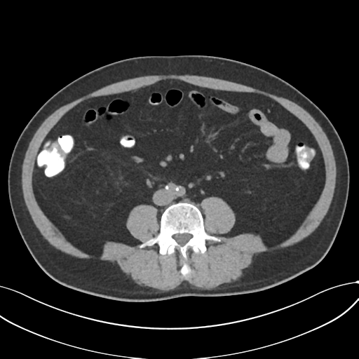 Cholecystitis with focal perforation and hepatic abscess (Radiopaedia 37189-38945 Axial non-contrast 49).png