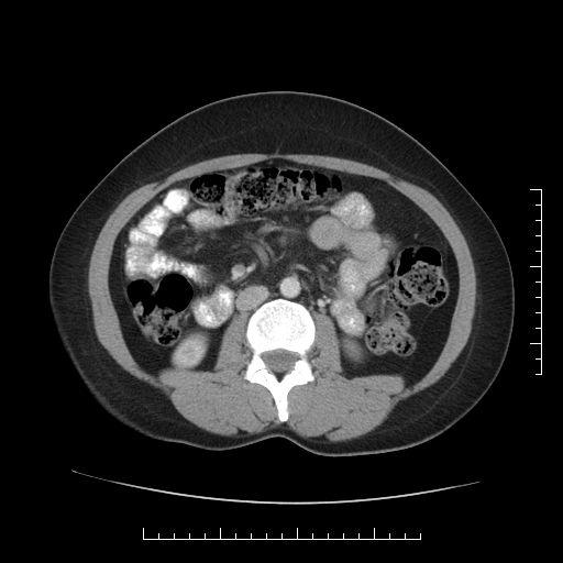 File:Choledochal cyst with chronic calcific pancreatitis (Radiopaedia 18245-18061 A 20).png