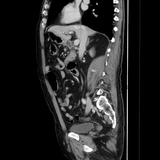 Choledocholiathiasis with normal caliber common bile duct (Radiopaedia 75368-86632 D 71).jpg