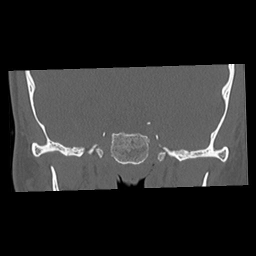 File:Cholesteatoma (Radiopaedia 84960-100474 Coronal bone window 15).jpg