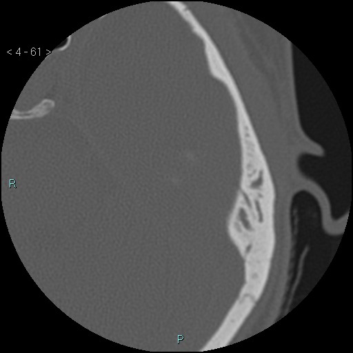 Cholesterol granuloma of the petrous apex (Radiopaedia 64358-73141 Axial bone window 29).jpg