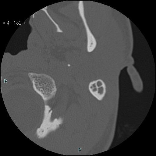 Cholesterol granuloma of the petrous apex (Radiopaedia 64358-73141 Axial bone window 88).jpg