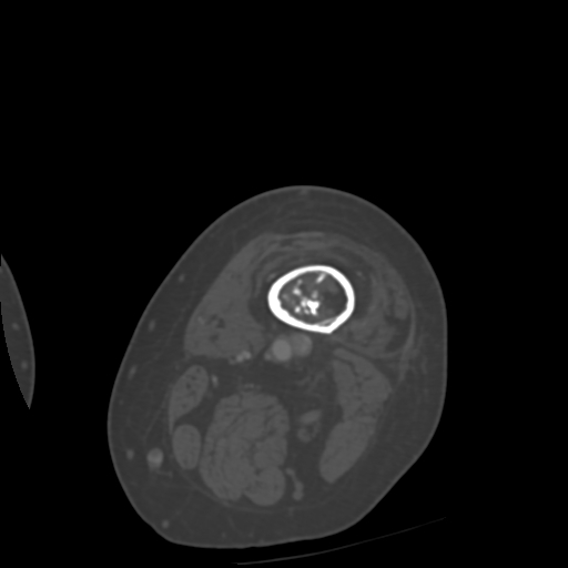 Chondrosarcoma - femur (Radiopaedia 64187-72954 Axial bone window 5).jpg