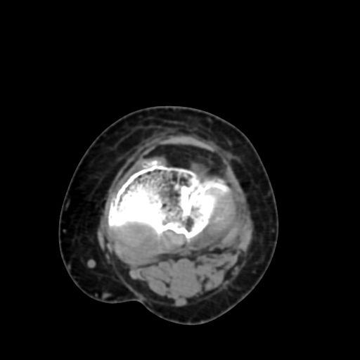 Chondrosarcoma - femur (Radiopaedia 64187-72954 Axial non-contrast 59).jpg