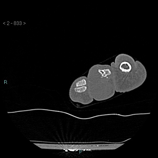 Chondrosarcoma - phalanx (Radiopaedia 69047-78812 Axial bone window 87).jpg