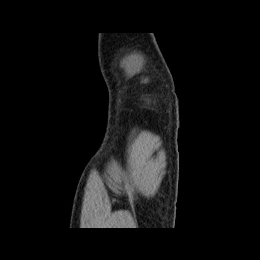 Chondrosarcoma of iliac wing (Radiopaedia 63861-72599 F 15).jpg